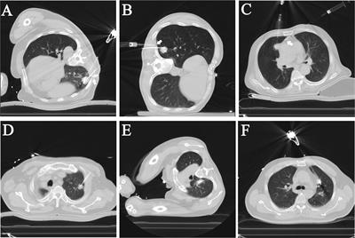 Microwave ablation with local pleural anesthesia for subpleural pulmonary nodules: our experience